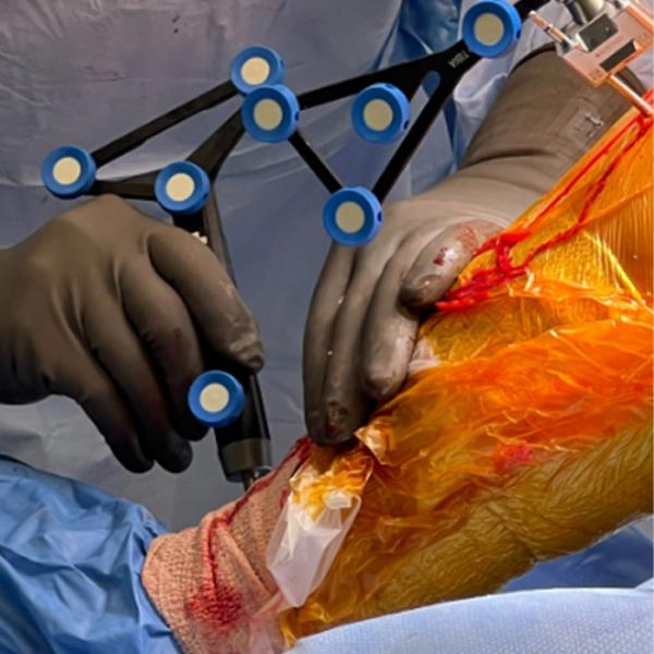 A physician using a tool to perform orthopedic surgery